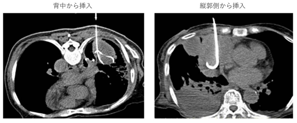 公式 膿胸とは 湘南鎌倉総合病院